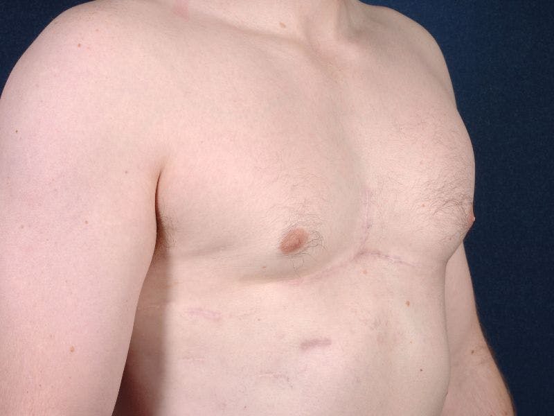Pectoral Augmentation Before & After Gallery - Patient 9710118 - Image 5