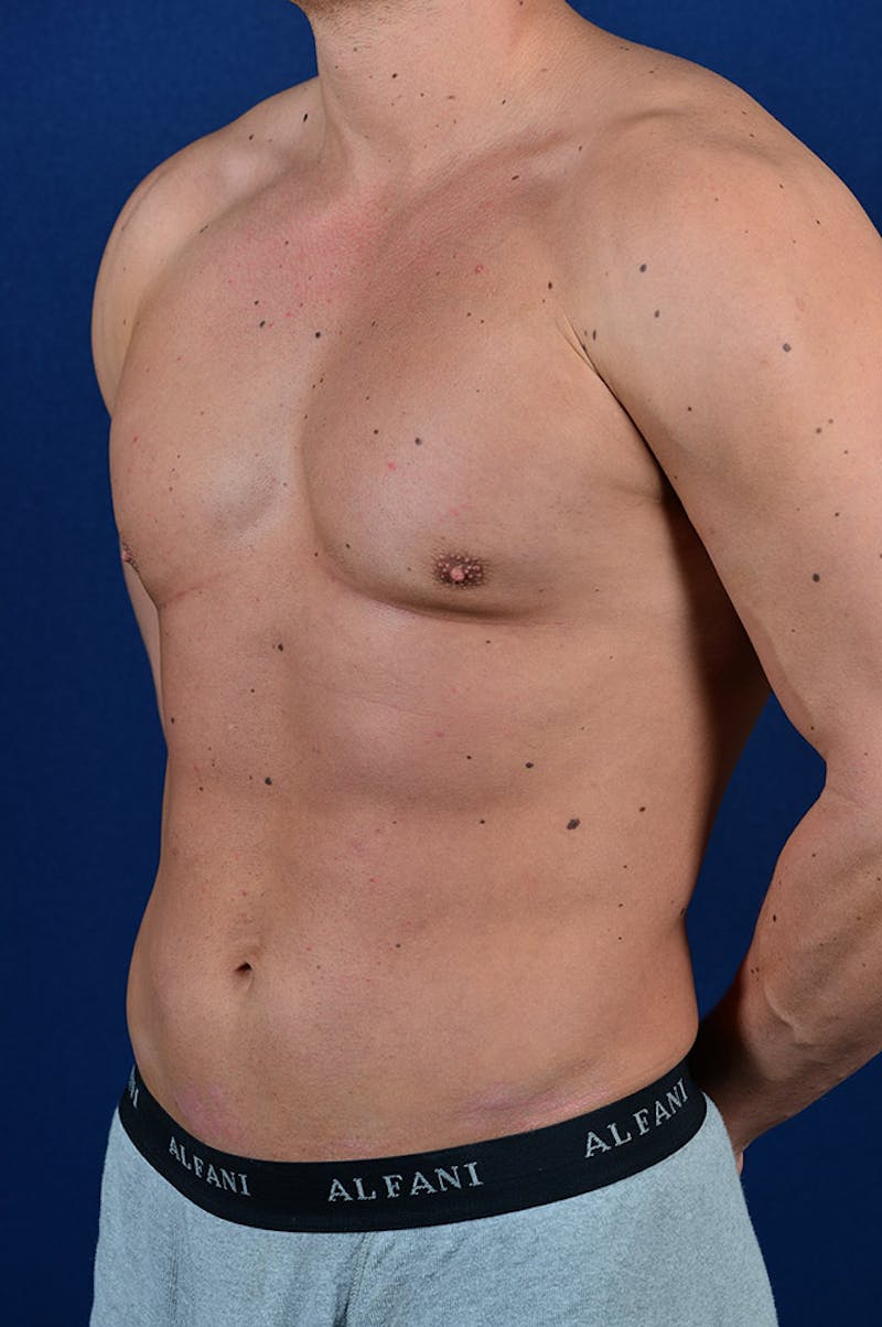 Male Liposuction Before & After Gallery - Patient 9710121 - Image 3