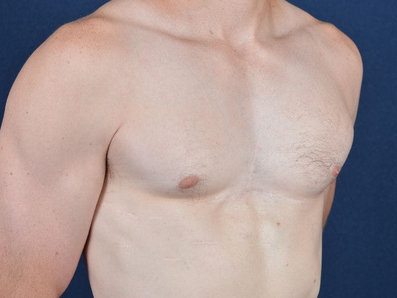 Pectoral Augmentation Before & After Gallery - Patient 9710118 - Image 6