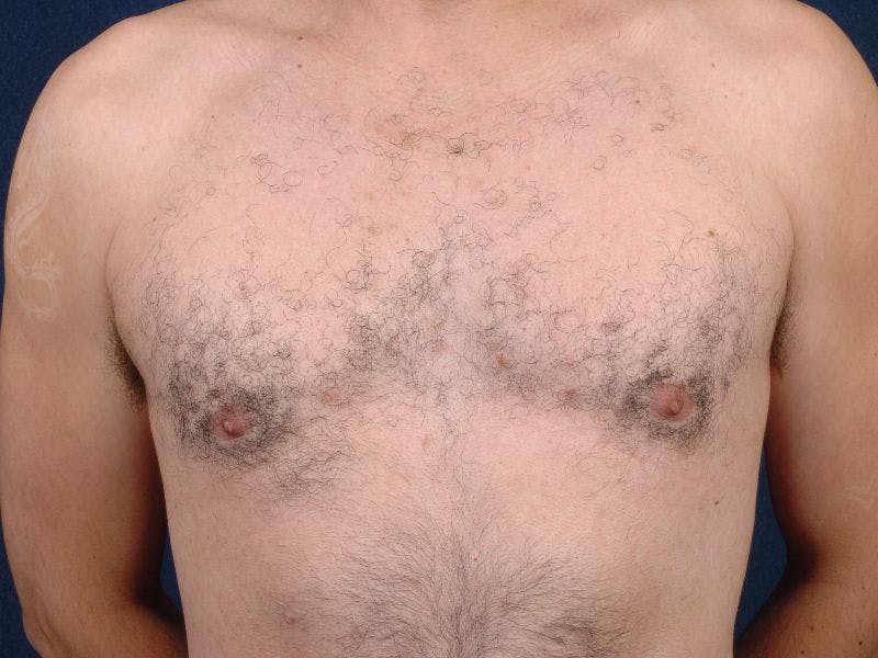 Pectoral Augmentation Before & After Gallery - Patient 9710124 - Image 1