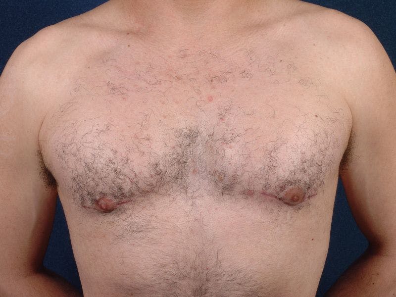 Pectoral Augmentation Before & After Gallery - Patient 9710124 - Image 2