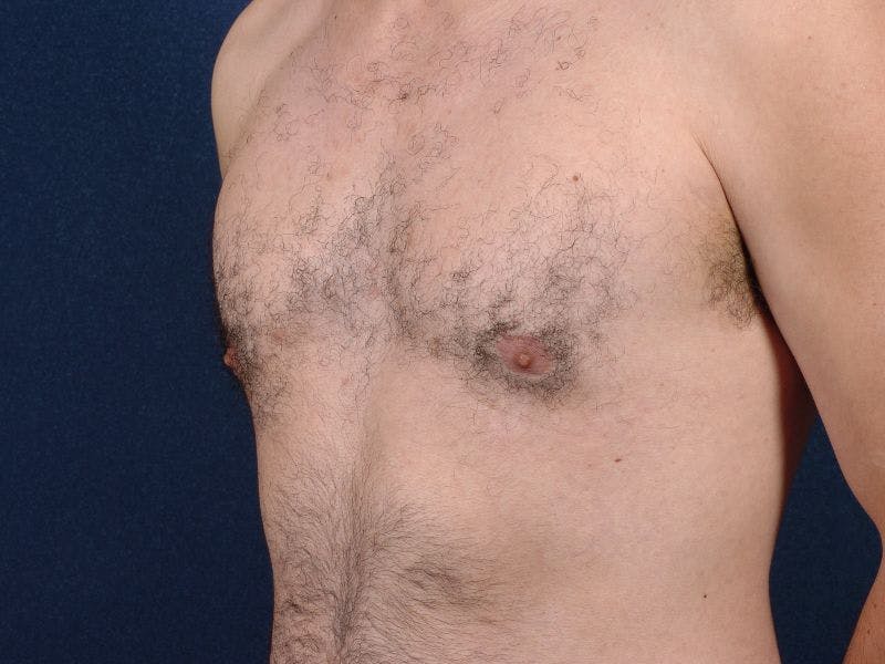 Pectoral Augmentation Before & After Gallery - Patient 9710124 - Image 3