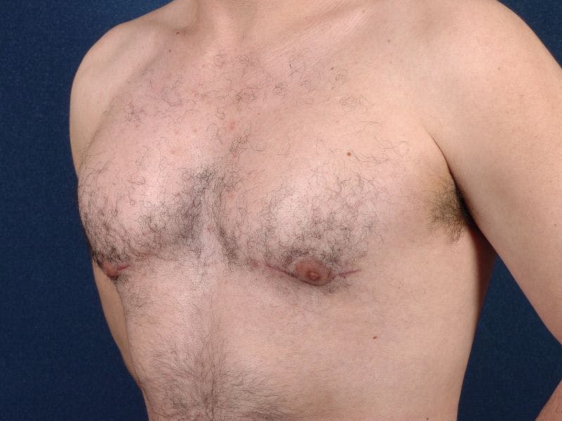 Pectoral Augmentation Before & After Gallery - Patient 9710124 - Image 4