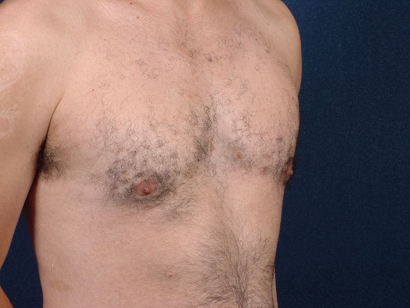 Pectoral Augmentation Before & After Gallery - Patient 9710124 - Image 5
