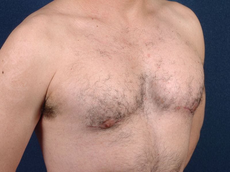 Pectoral Augmentation Before & After Gallery - Patient 9710124 - Image 6