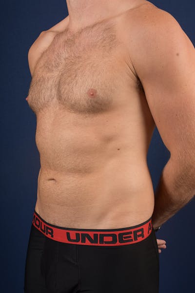 Male Liposuction Before & After Gallery - Patient 9710125 - Image 3