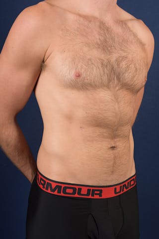 Male Liposuction Before & After Gallery - Patient 9710125 - Image 6