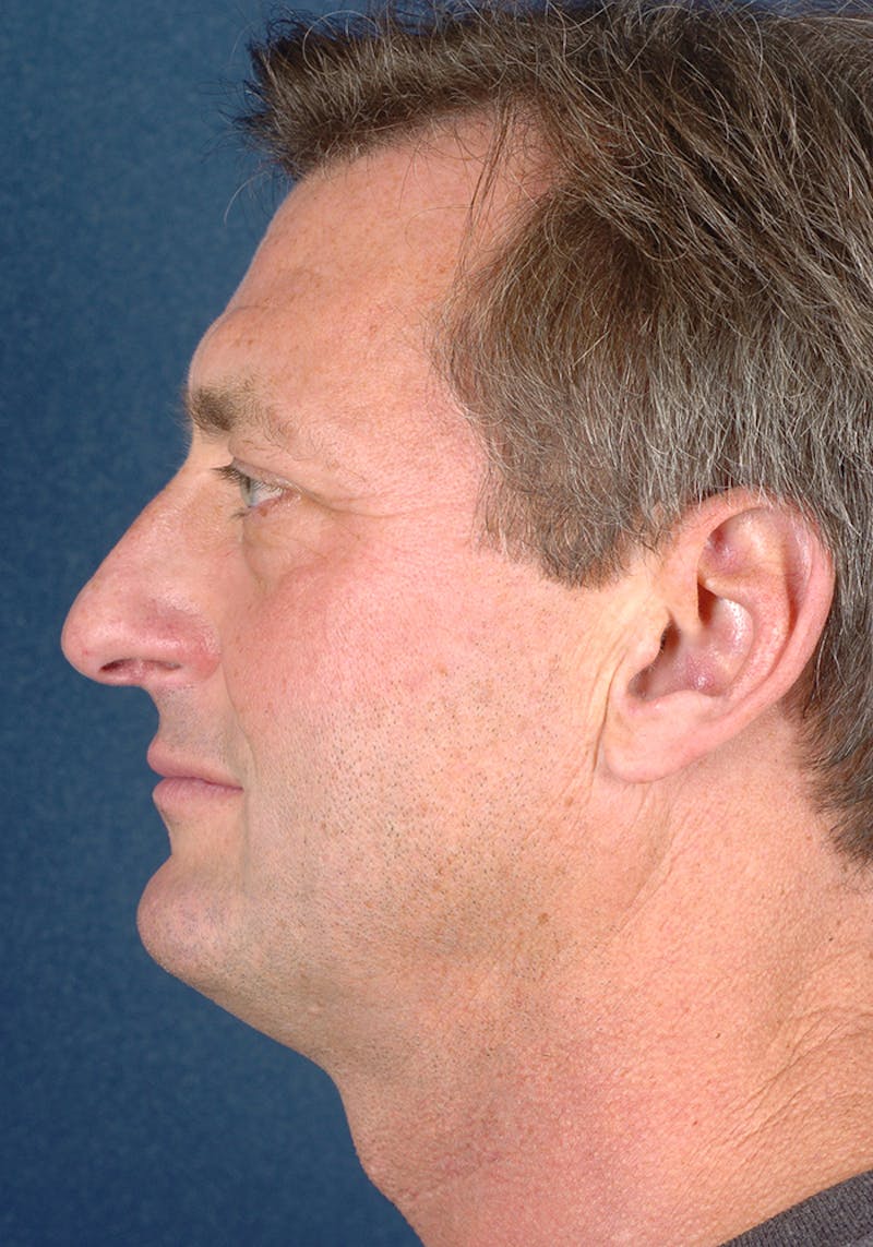 Rhinoplasty Before & After Gallery - Patient 9710128 - Image 5