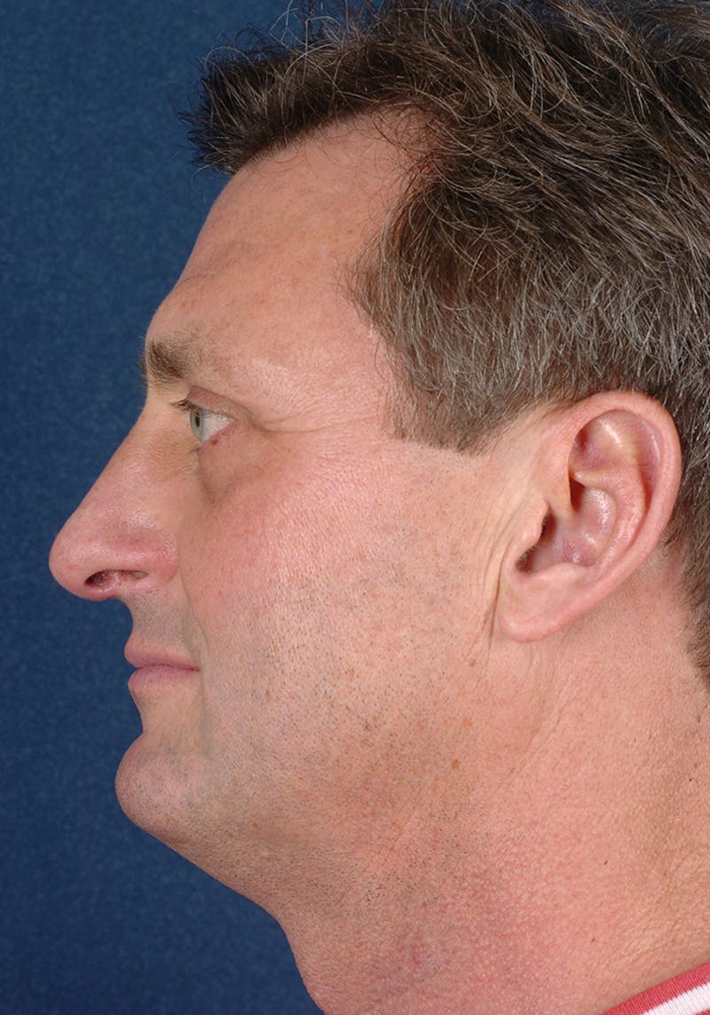 Rhinoplasty Before & After Gallery - Patient 9710128 - Image 6