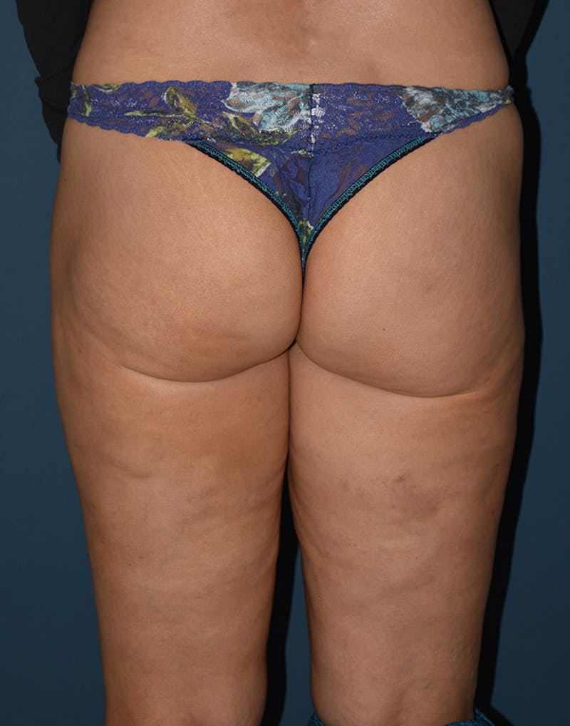 Cellulite Reduction Before & After Gallery - Patient 9710231 - Image 2