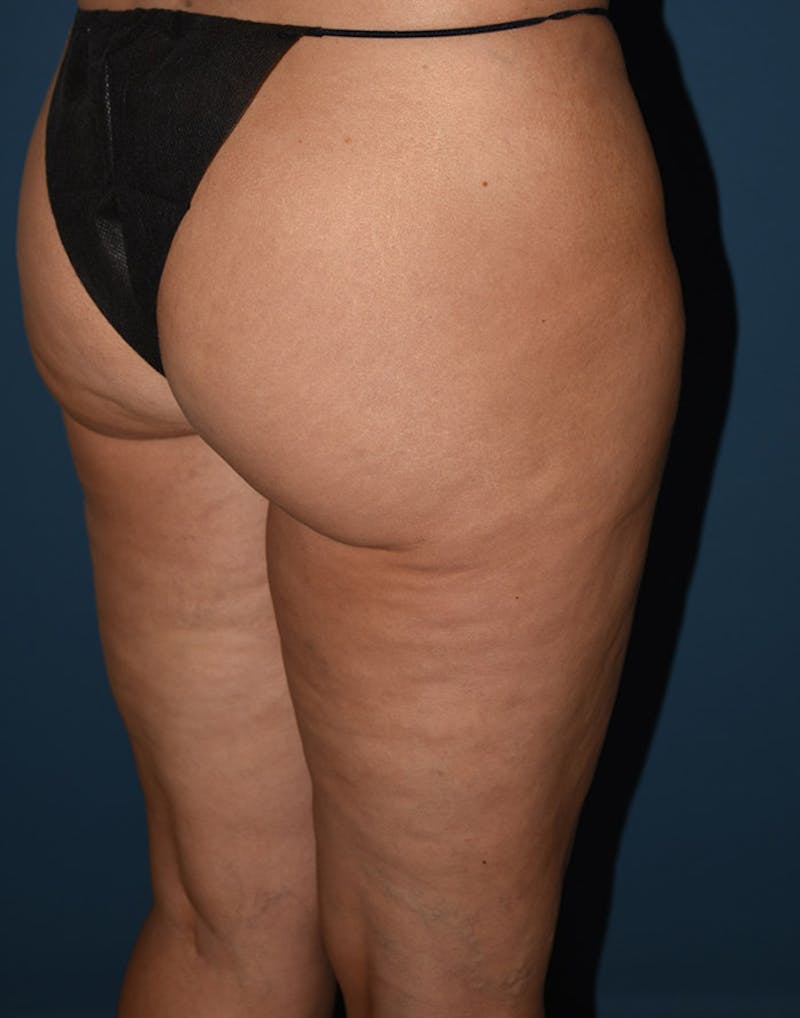 Cellulite Reduction Before & After Gallery - Patient 9710231 - Image 3