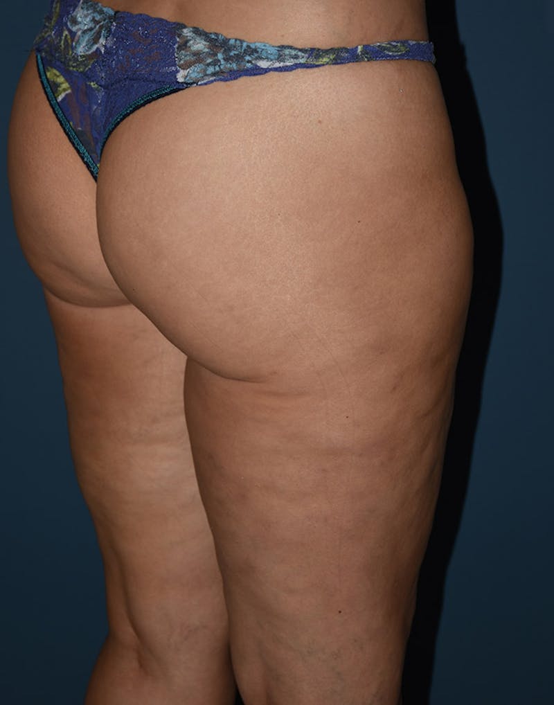 Cellulite Reduction Before & After Gallery - Patient 9710231 - Image 4