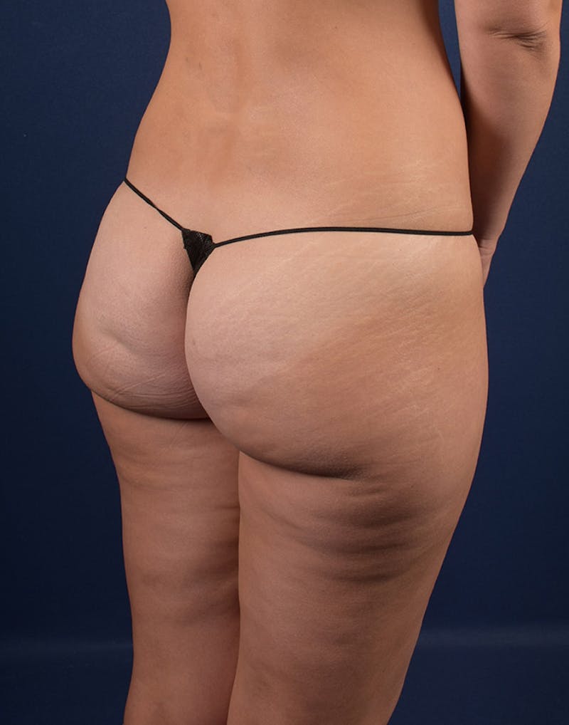 Cellulite Reduction Before & After Gallery - Patient 9710236 - Image 3