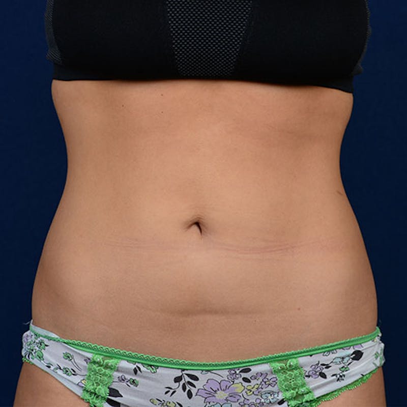 Coolsculpting Gallery - Patient 9710238 - Image 1
