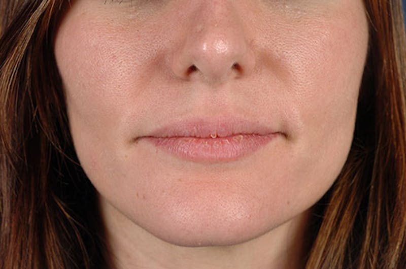 Facial Fillers Before & After Gallery - Patient 9710235 - Image 1