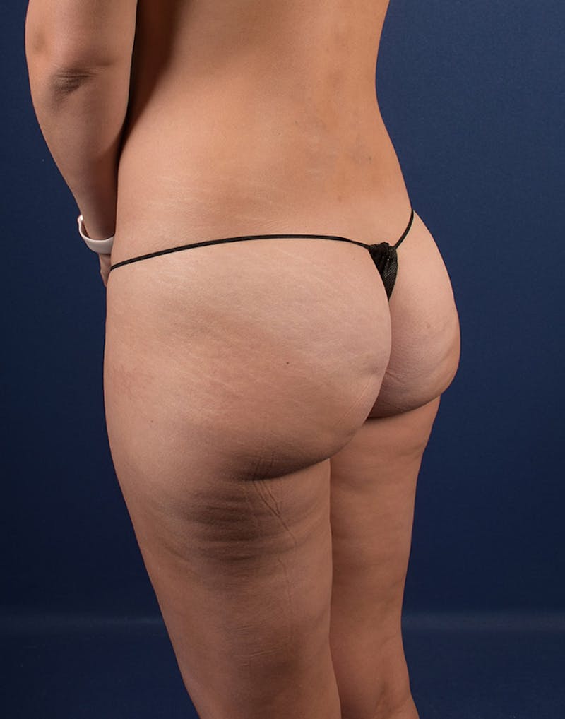 Cellulite Reduction Before & After Gallery - Patient 9710236 - Image 5