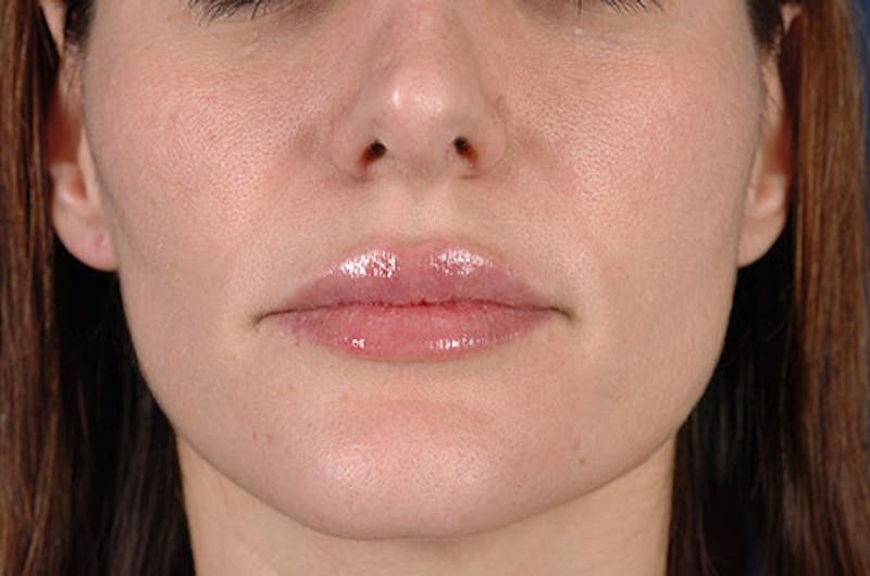 Facial Fillers Before & After Gallery - Patient 9710235 - Image 2