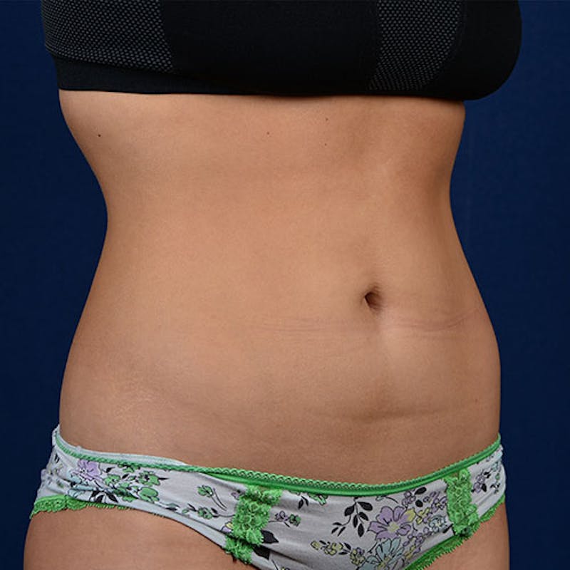 Coolsculpting Before & After Gallery - Patient 9710238 - Image 3