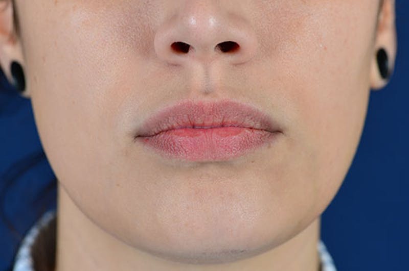Facial Fillers Before & After Gallery - Patient 9710237 - Image 1