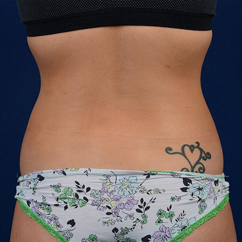 Coolsculpting Before & After Gallery - Patient 9710238 - Image 5