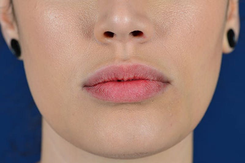 Facial Fillers Before & After Gallery - Patient 9710237 - Image 2