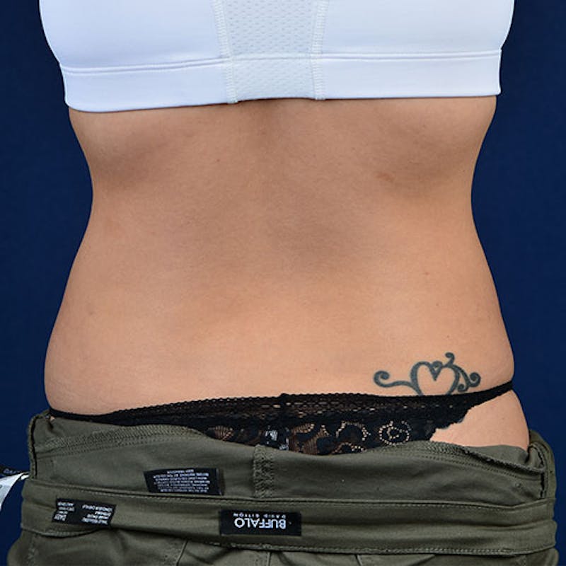 Coolsculpting Before & After Gallery - Patient 9710238 - Image 6