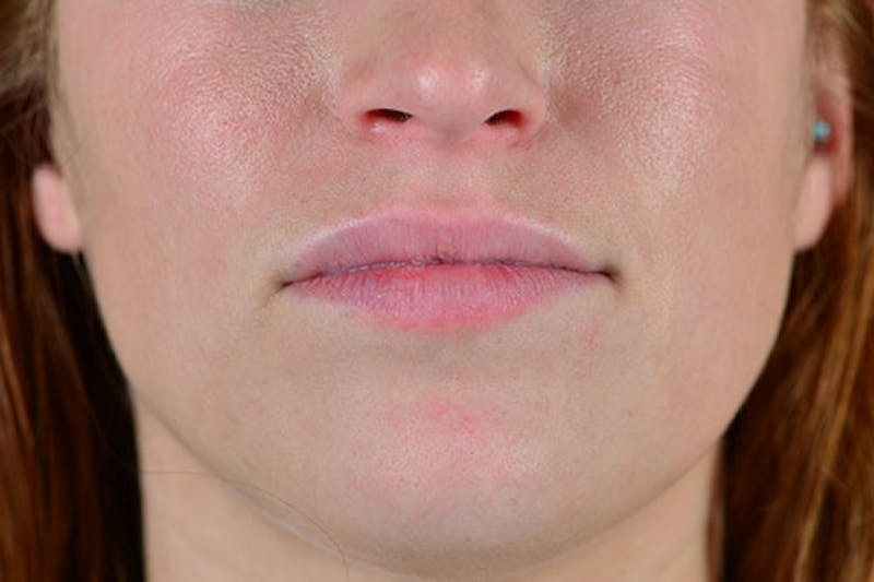 Facial Fillers Before & After Gallery - Patient 9710240 - Image 1