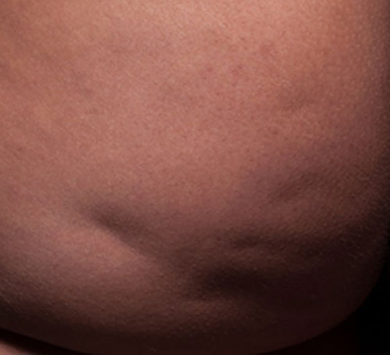 Cellulite Reduction Before & After Gallery - Patient 9710242 - Image 1