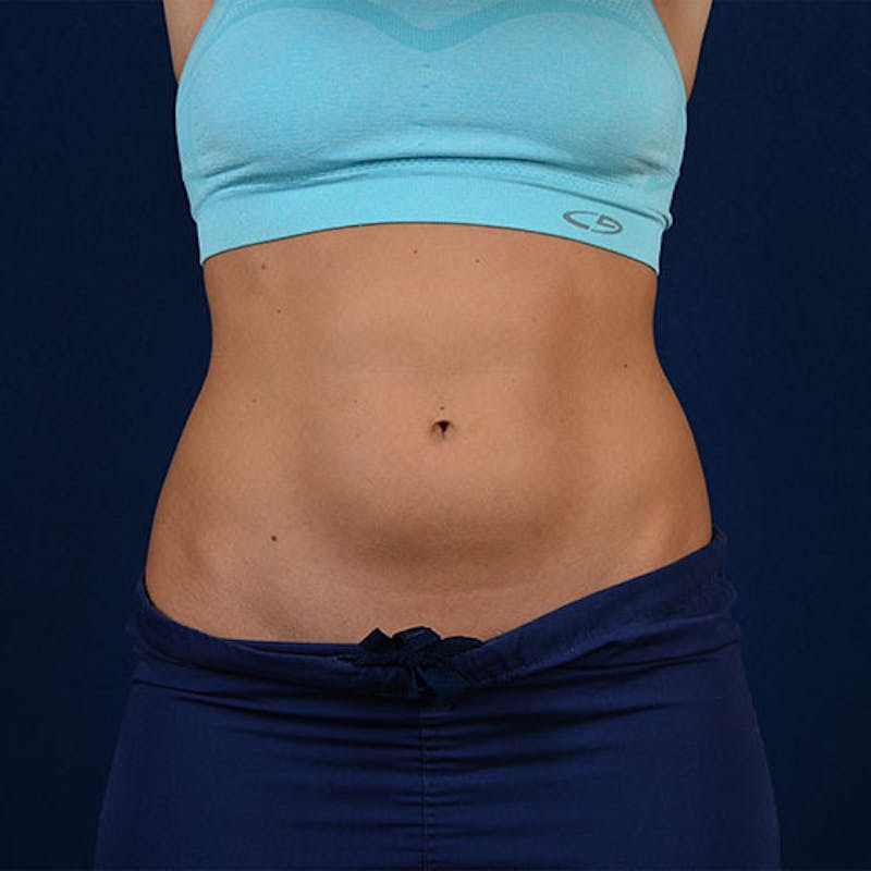 Coolsculpting Gallery - Patient 9710247 - Image 1