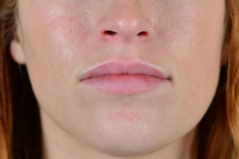 Facial Fillers Before & After Gallery - Patient 9710240 - Image 2