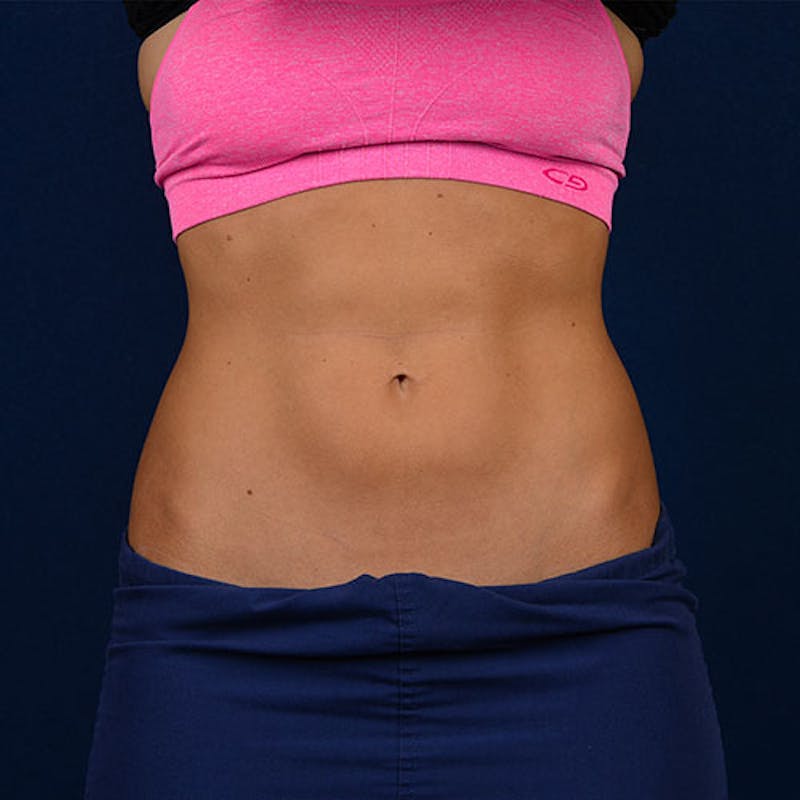 Coolsculpting Before & After Gallery - Patient 9710247 - Image 2