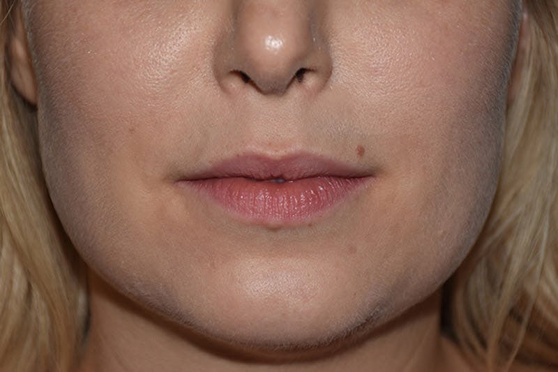 Facial Fillers Before & After Gallery - Patient 9710248 - Image 1