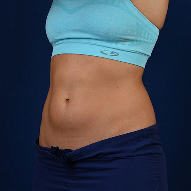 Coolsculpting Gallery - Patient 9710247 - Image 3