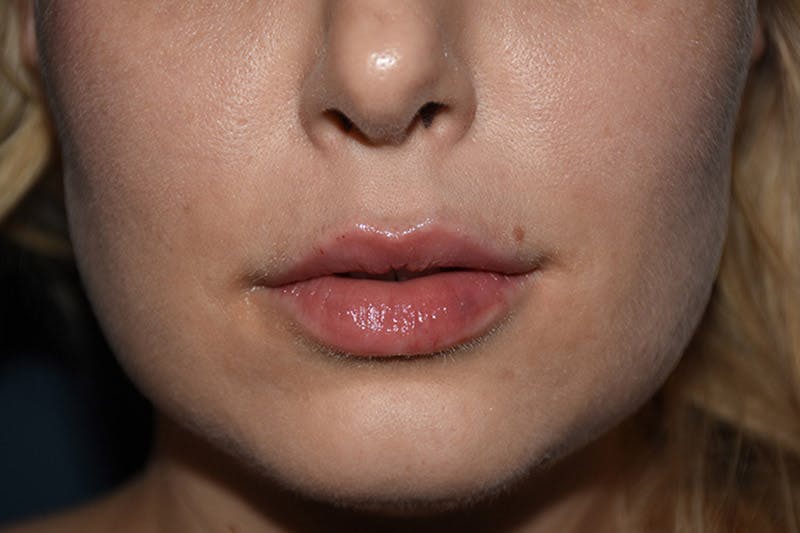 Facial Fillers Before & After Gallery - Patient 9710248 - Image 2