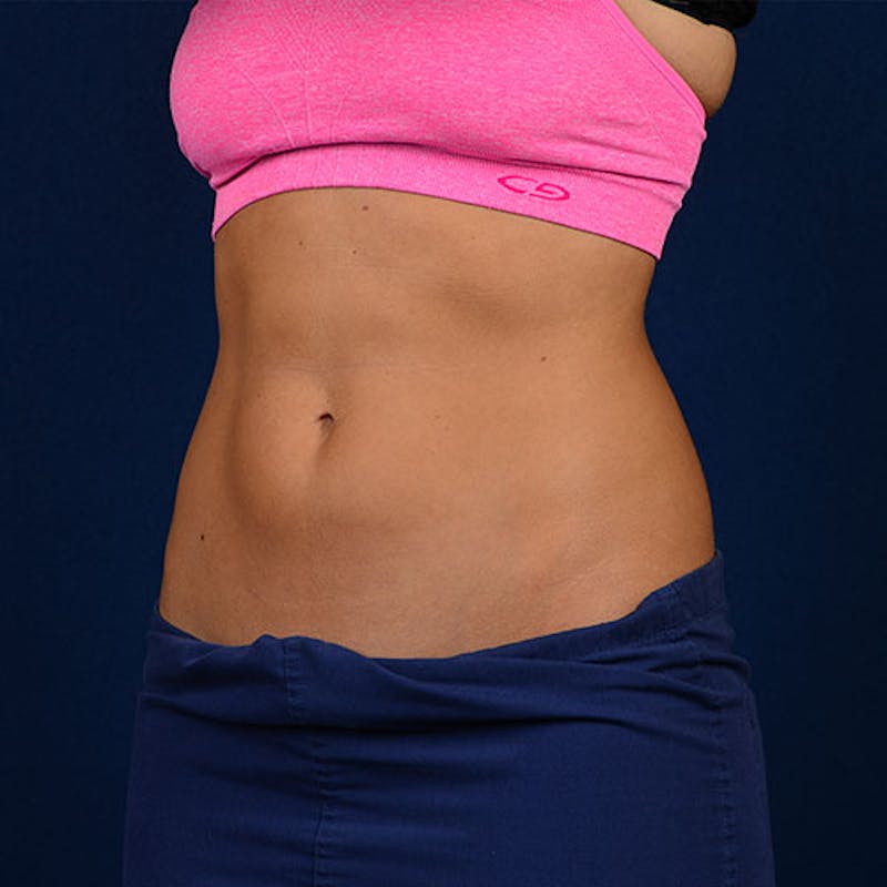 Coolsculpting Gallery - Patient 9710247 - Image 4