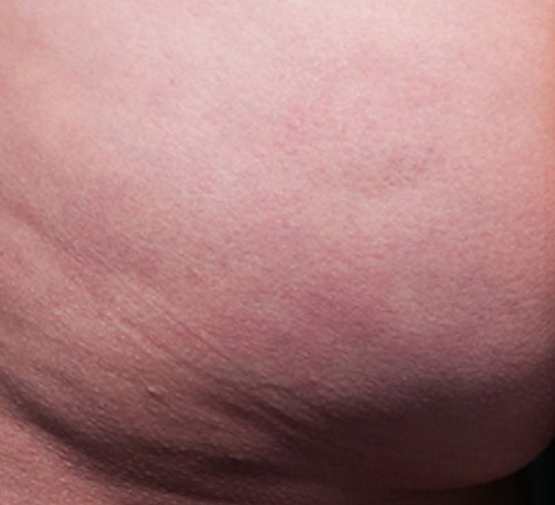 Cellulite Reduction Before & After Gallery - Patient 9710243 - Image 2