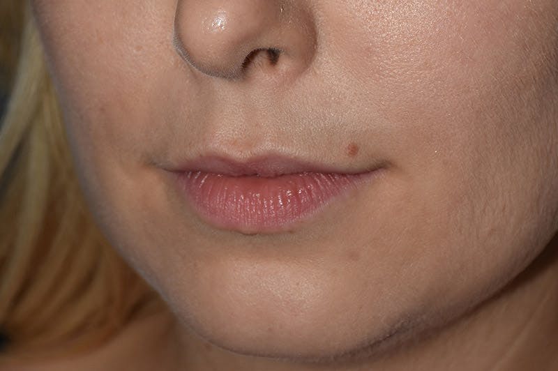Facial Fillers Before & After Gallery - Patient 9710248 - Image 3