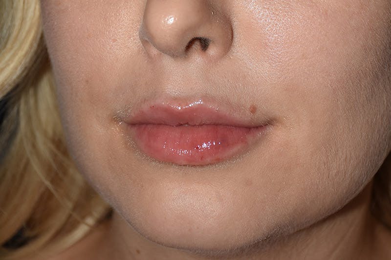Facial Fillers Before & After Gallery - Patient 9710248 - Image 4