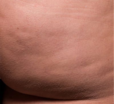 Cellulite Reduction Before & After Gallery - Patient 9710249 - Image 2