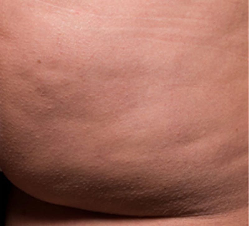 Cellulite Reduction Before & After Gallery - Patient 9710249 - Image 2