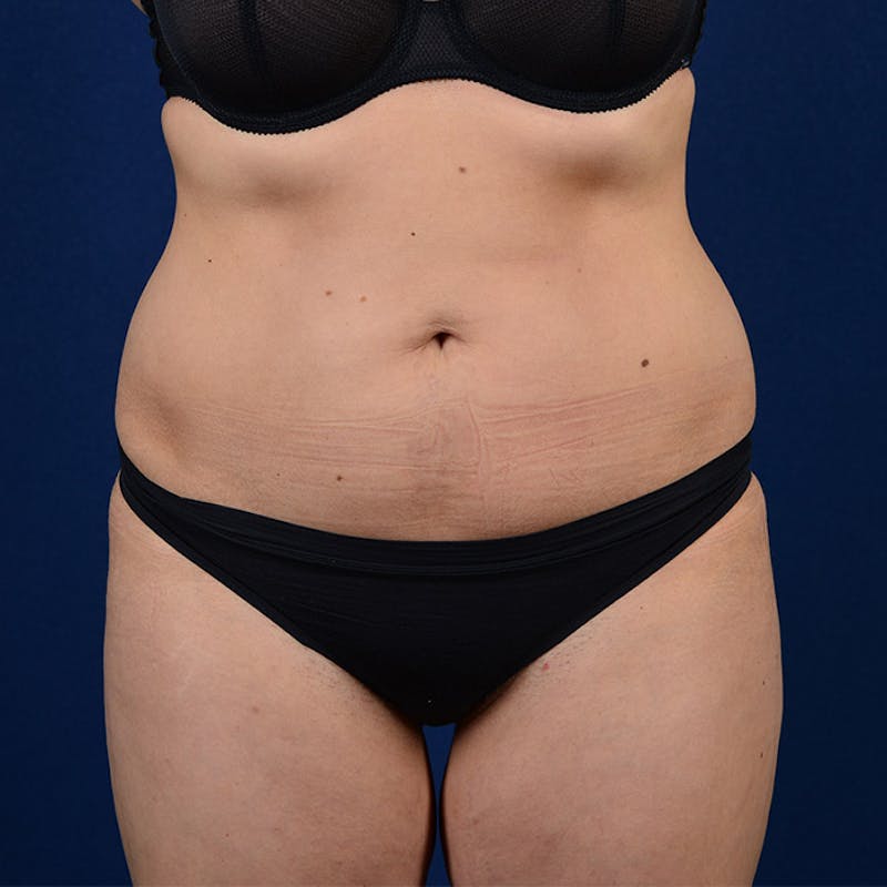Coolsculpting Gallery - Patient 9710256 - Image 1