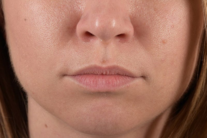 Facial Fillers Before & After Gallery - Patient 9710252 - Image 1