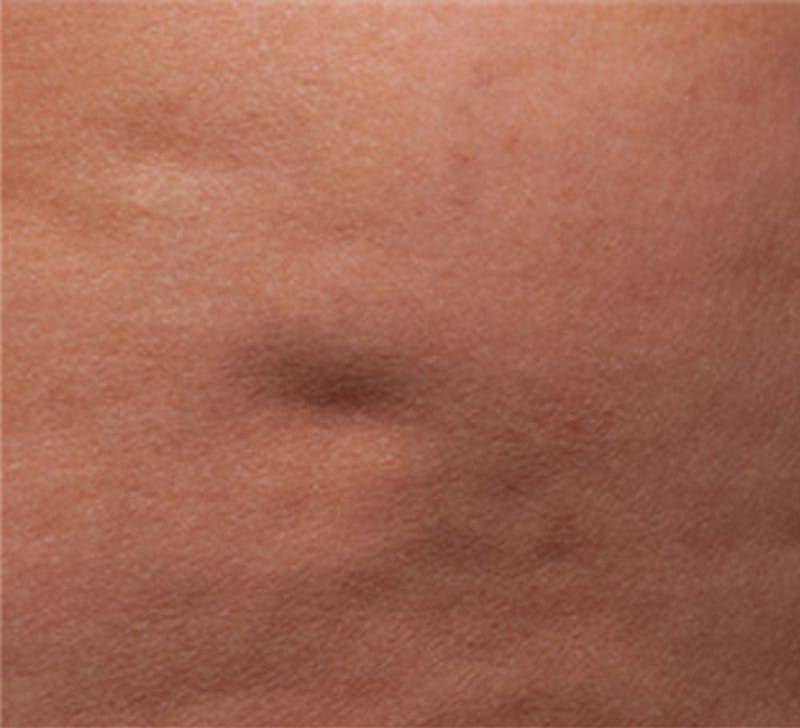 Cellulite Reduction Before & After Gallery - Patient 9710250 - Image 1
