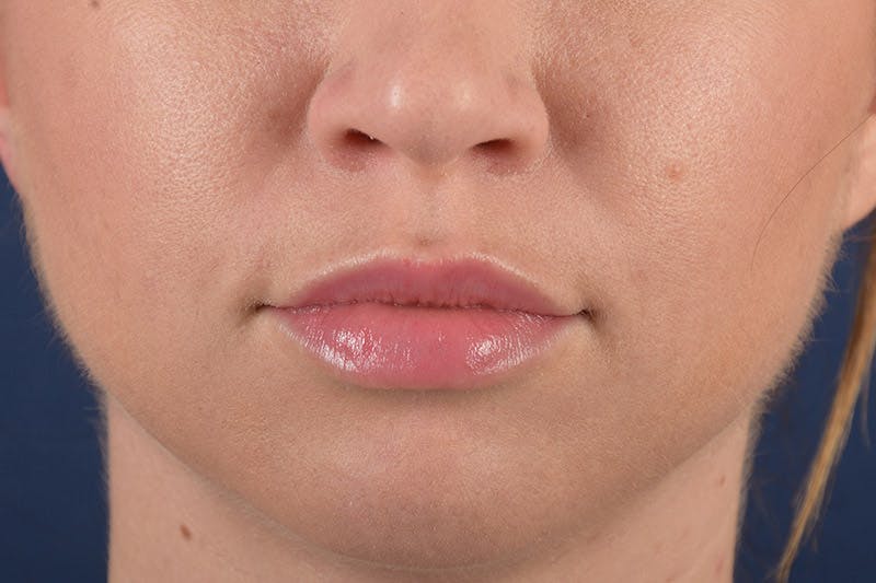 Facial Fillers Before & After Gallery - Patient 9710252 - Image 2