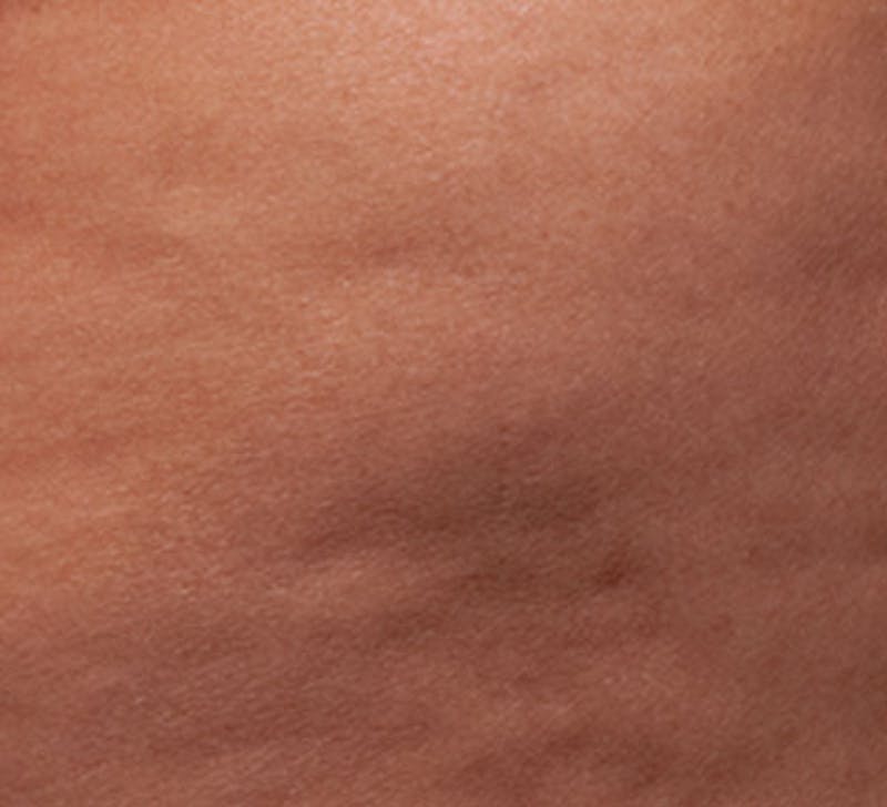 Cellulite Reduction Before & After Gallery - Patient 9710250 - Image 2