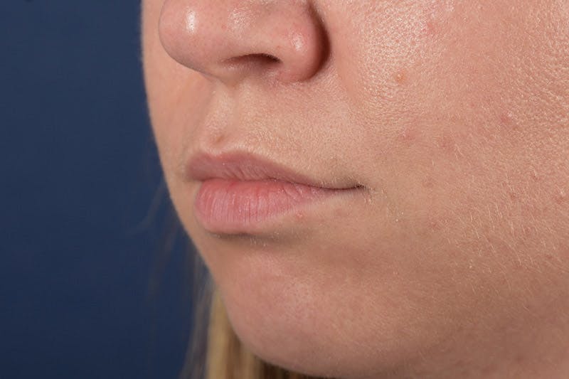 Facial Fillers Gallery - Patient 9710252 - Image 3