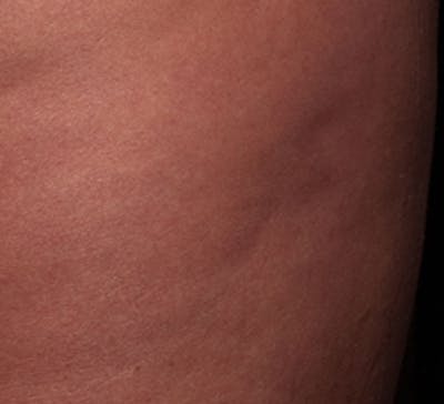 Cellulite Reduction Before & After Gallery - Patient 9710251 - Image 1