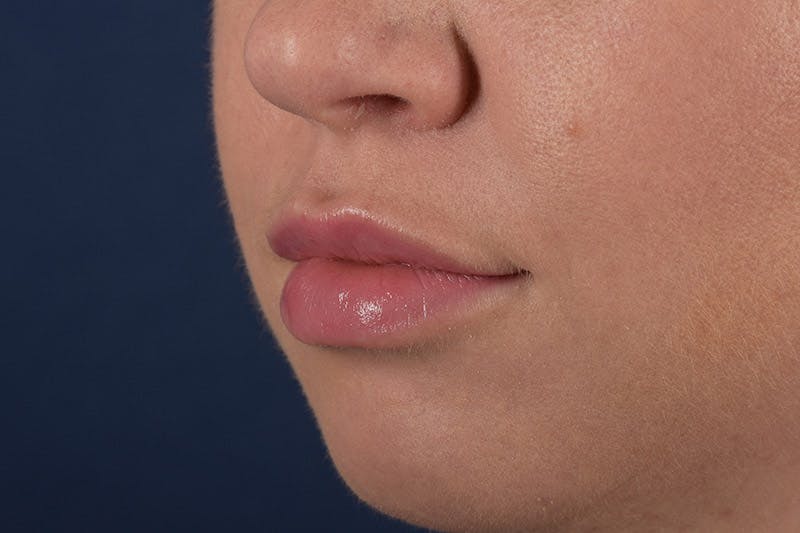 Facial Fillers Before & After Gallery - Patient 9710252 - Image 4