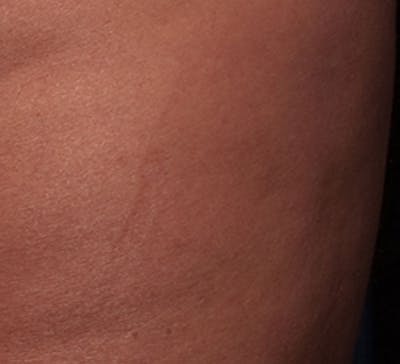 Cellulite Reduction Before & After Gallery - Patient 9710251 - Image 2