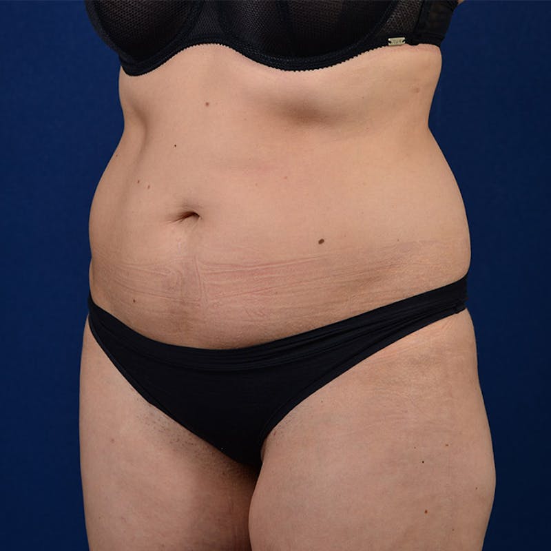 Coolsculpting Before & After Gallery - Patient 9710256 - Image 3